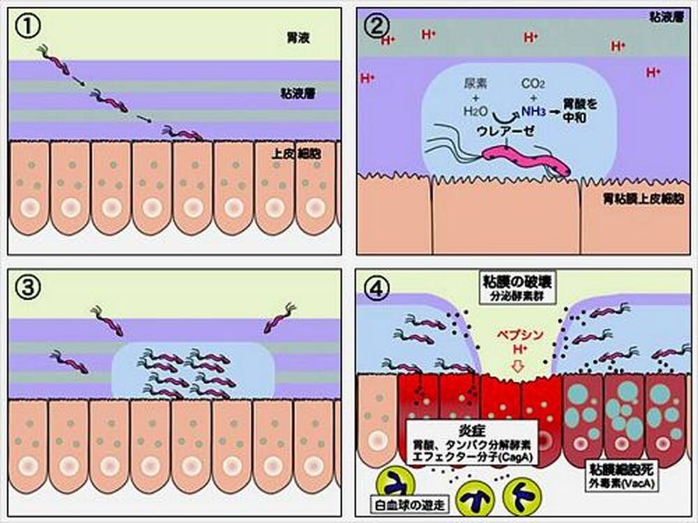 胃病與幽門螺旋桿菌